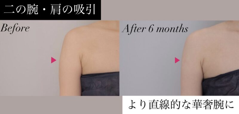 【もたつきを無くしてすっきり！】二の腕・肩のラインを美しく