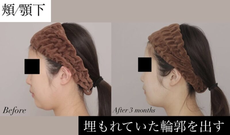 【フェイスライン激変！】埋もれていた輪郭を引き出す小顔術