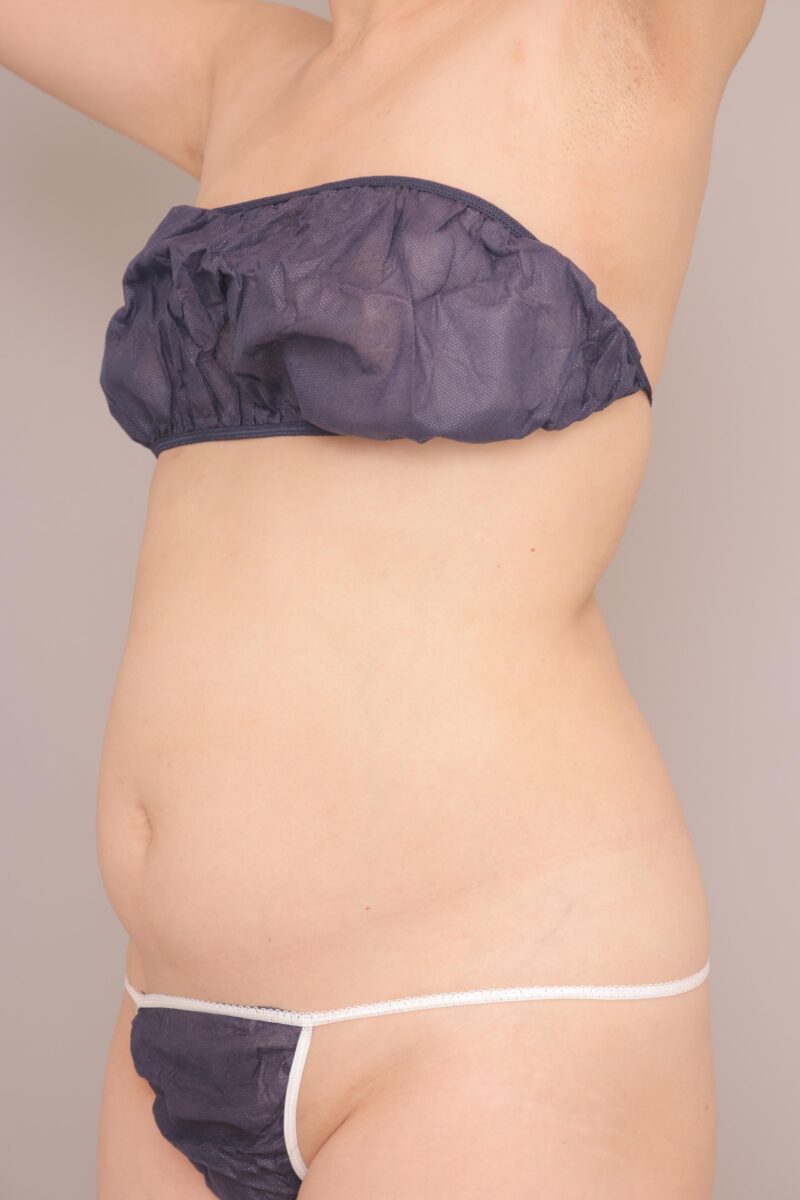 ベイザー脂肪吸引（半年後経過：46）の術前写真