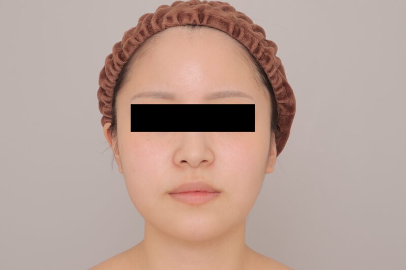 ベイザー脂肪吸引（3ヶ月経過：22）の術前写真