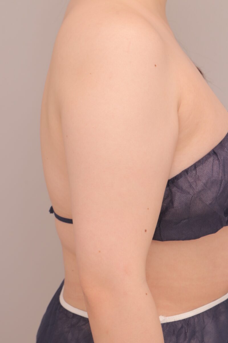ベイザー脂肪吸引（1か月後経過：28）の術前写真