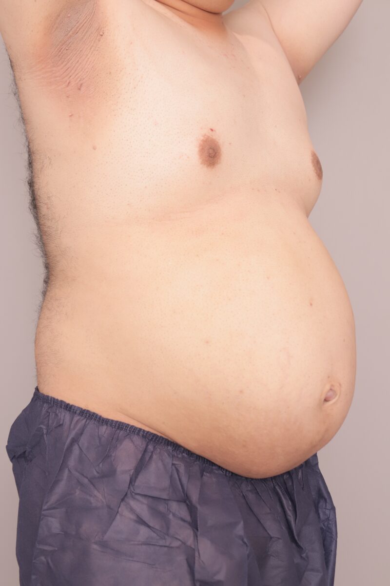 ベイザー脂肪吸引（半年経過：39）の術後写真