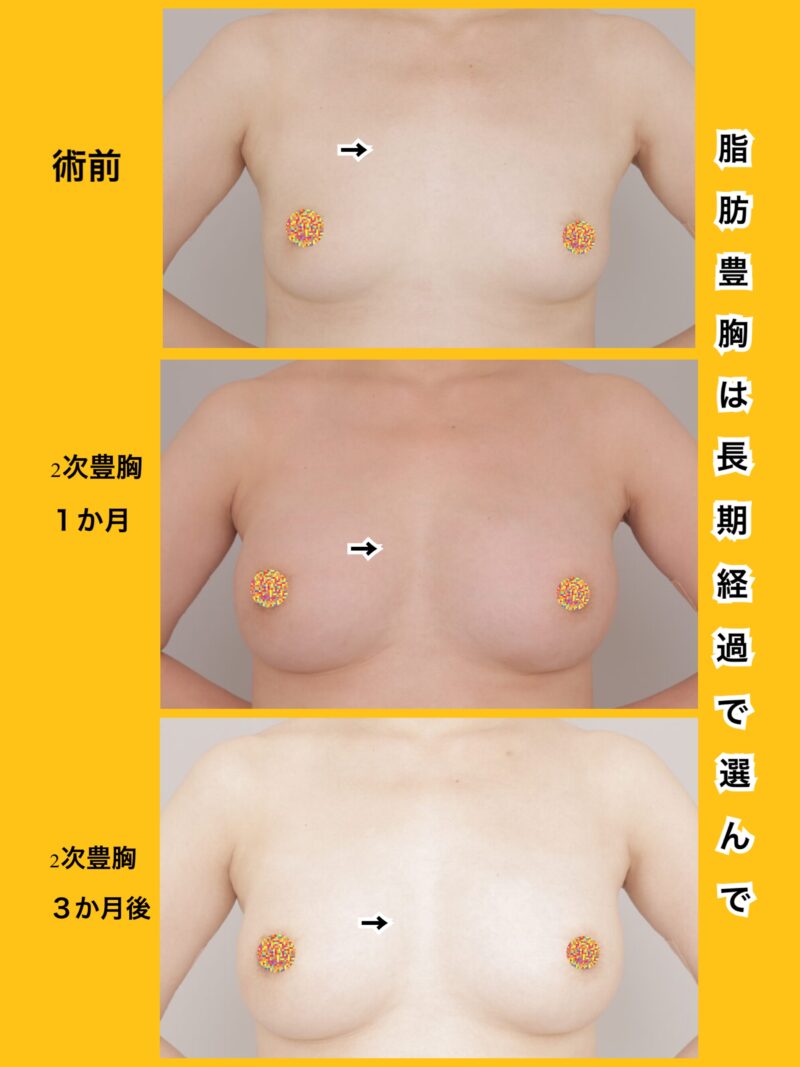 大きさと形どちらも大事。”綺麗に大きく”できます。～32歳168cm63kg脂肪豊胸（CRFバスト）時系列2次豊胸1か月3か月～