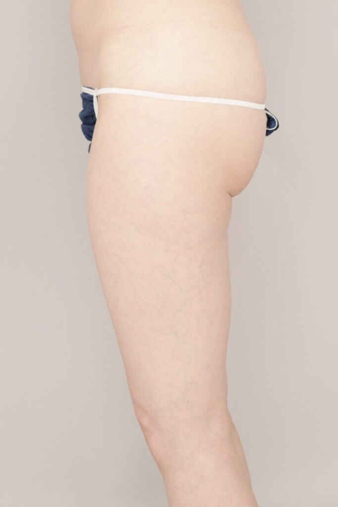 術前
