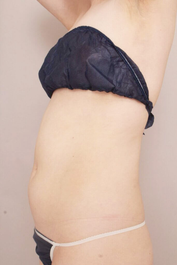 術前