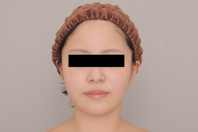 ベイザー脂肪吸引（3ヶ月経過：22）の術後写真