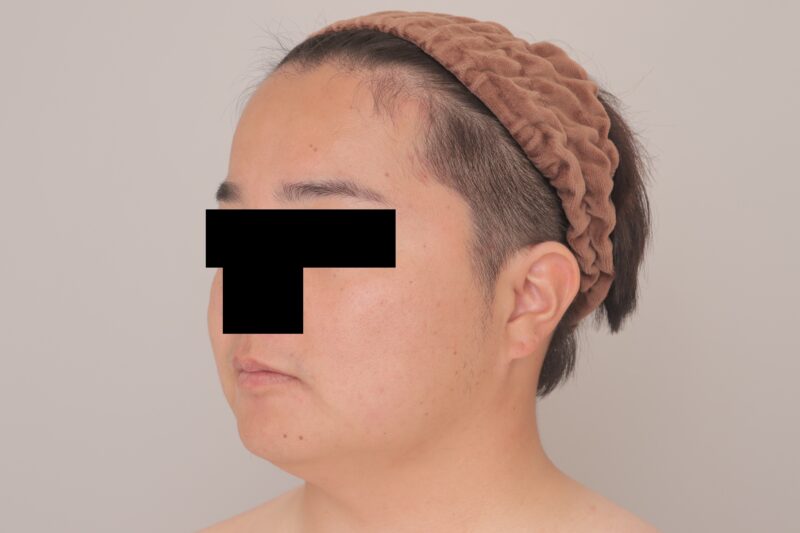 ベイザー脂肪吸引（8ヶ月経過：29）の術前写真