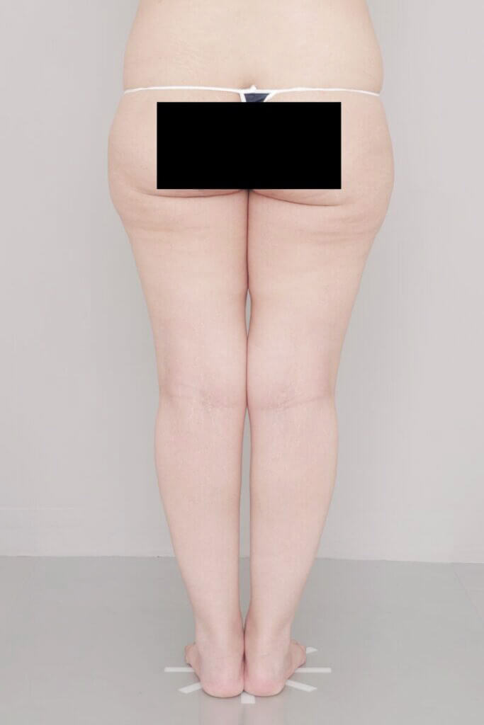 術前