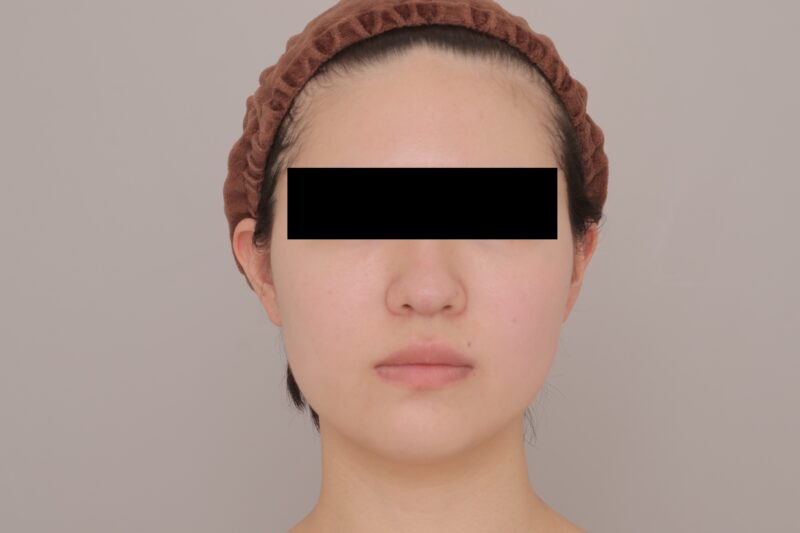 ベイザー脂肪吸引（3ヶ月経過：22）の術前写真