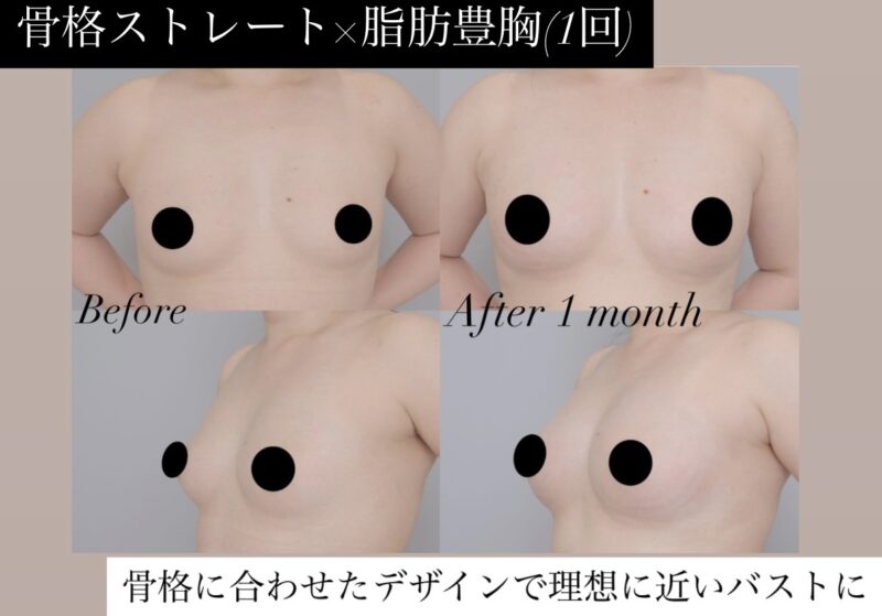 ベイザー脂肪吸引（1か月経過：31）の術前写真