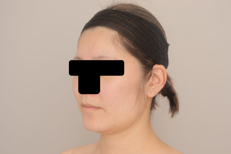 ベイザー脂肪吸引（３か月経過：27）の術前写真