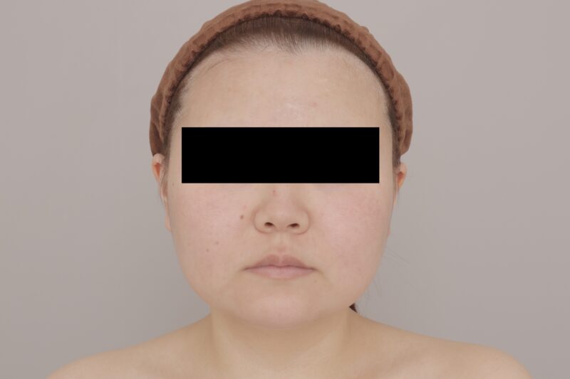 ベイザー脂肪吸引（3ヶ月経過：24）の術前写真