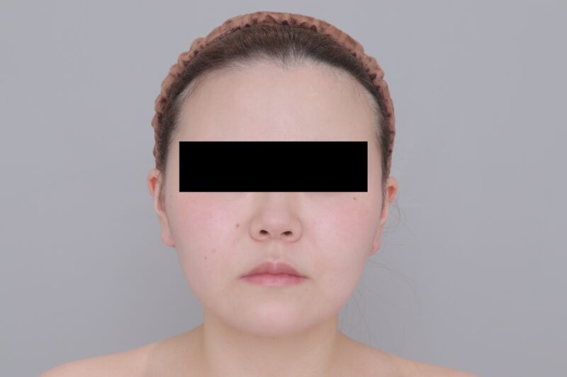 ベイザー脂肪吸引（3ヶ月経過：24）の術後写真