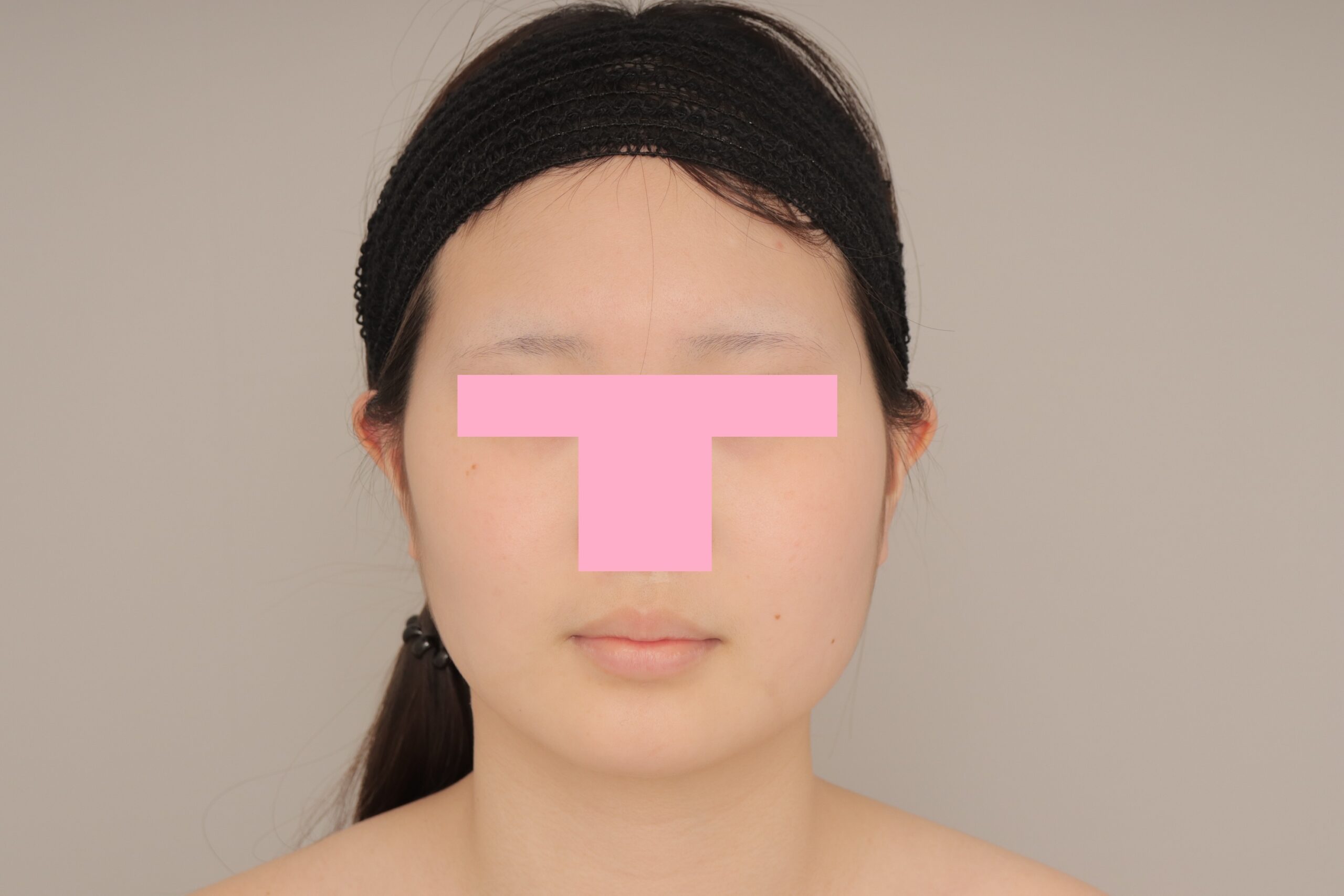 ベイザー脂肪吸引（3か月経過：17）の術前写真