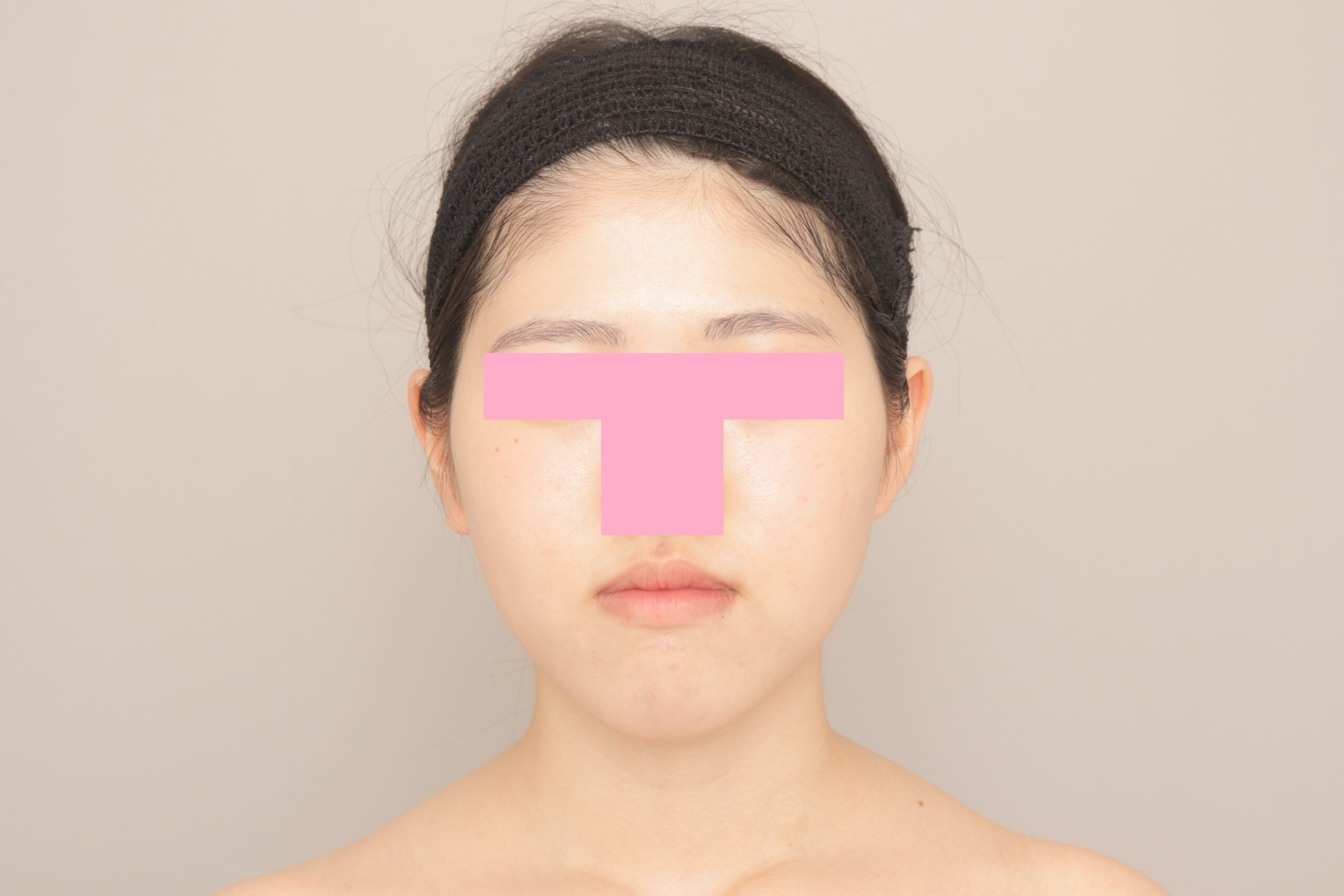 ベイザー脂肪吸引（3か月経過：19）の術後写真