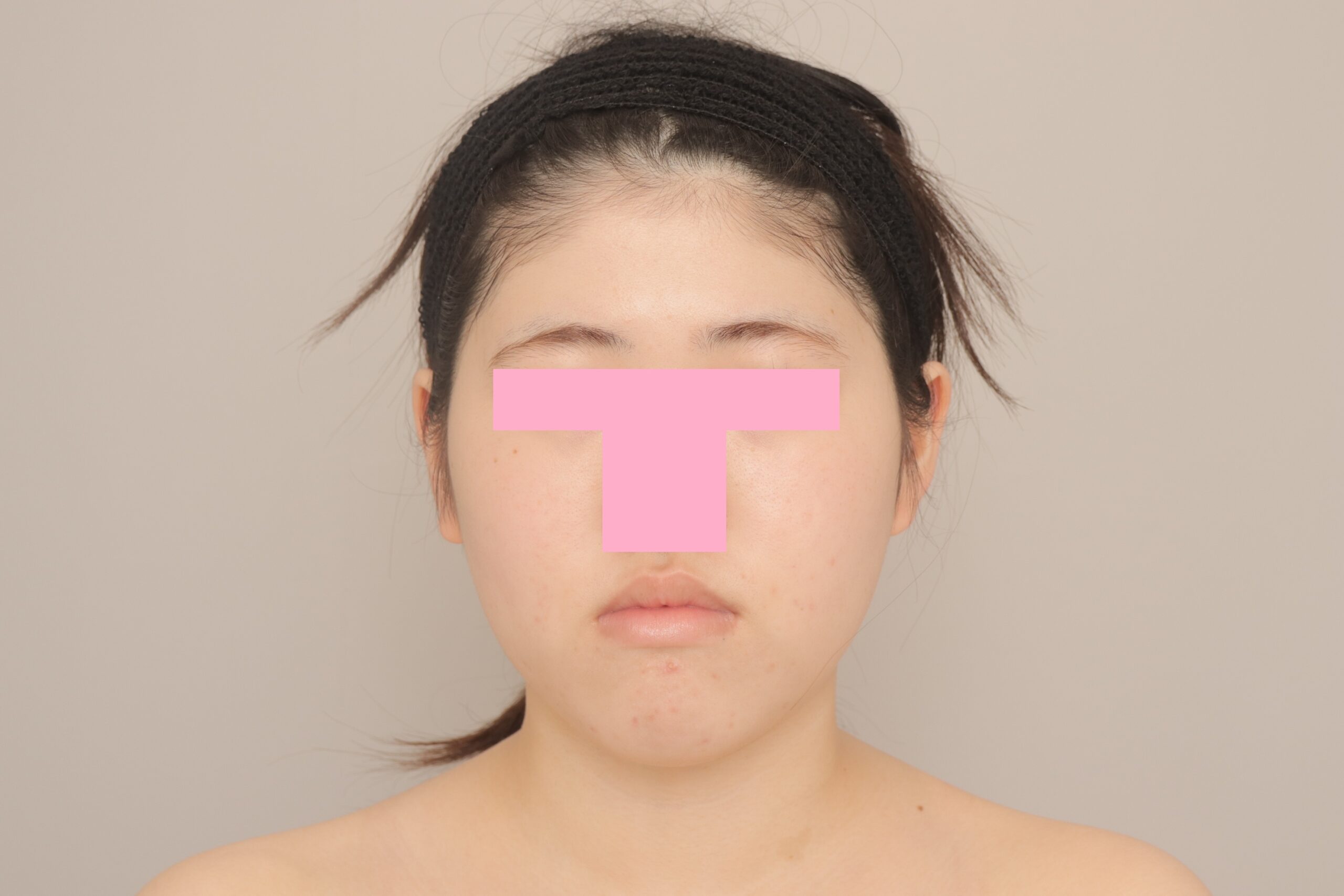 ベイザー脂肪吸引（3か月経過：19）の術前写真