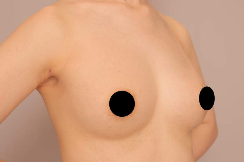ベイザー脂肪吸引（9ヶ月後経過：40）の術後写真