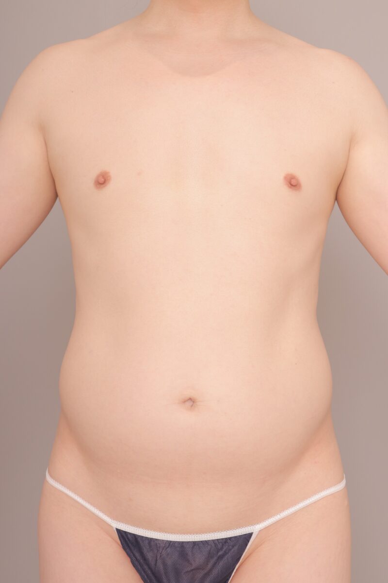 ベイザー脂肪吸引（3か月後経過：44）の術前写真