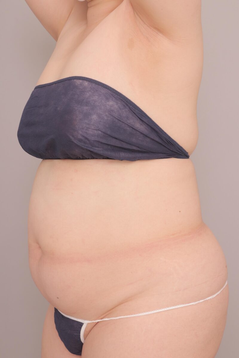 ベイザー脂肪吸引(半年経過:48)の術前写真