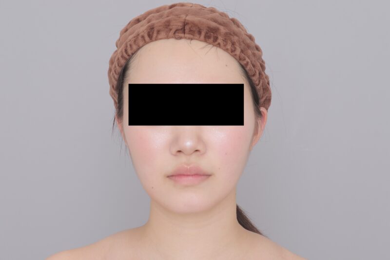 ベイザー脂肪吸引（3ヶ月経過：22）の術後写真