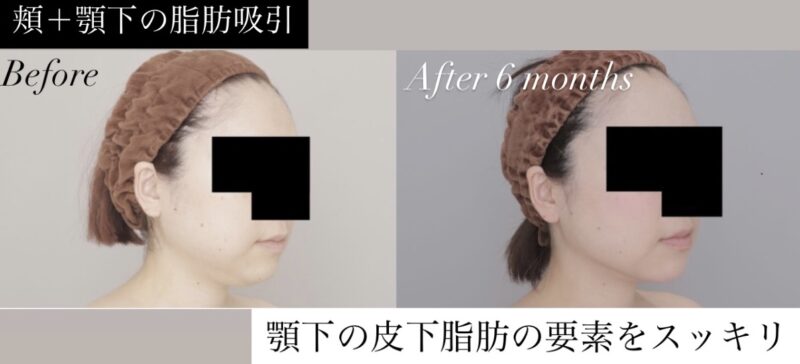 ●【頬+顎下】40代女性 162cm 49kgのモニター様●