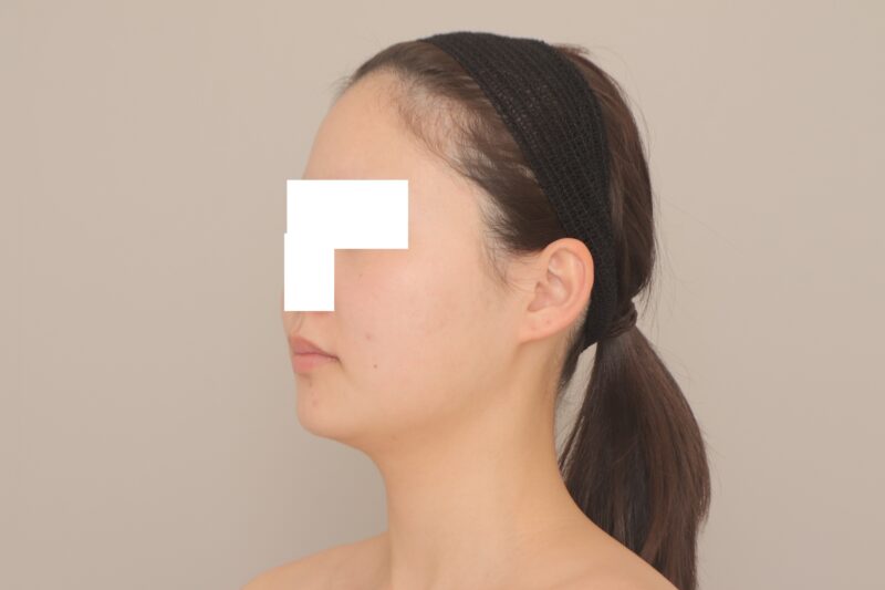 ベイザー脂肪吸引（3ヶ月経過：21）の術前写真