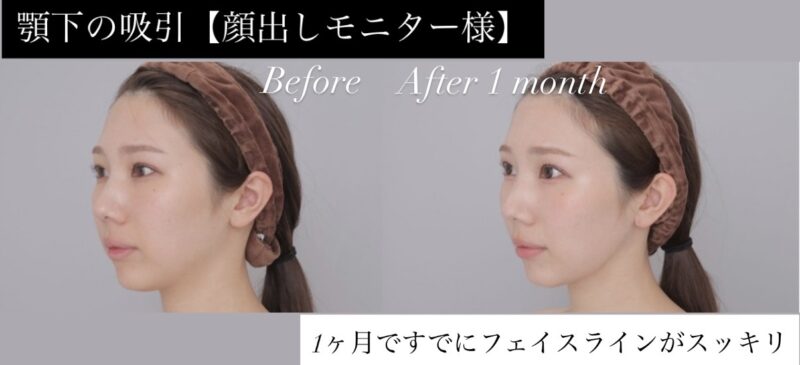 ●【顎下】20代女性 顔出しモニター様●