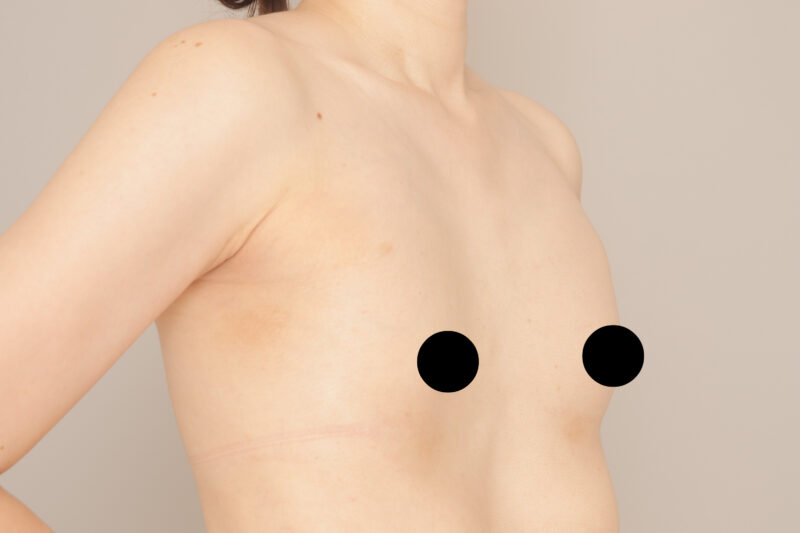 ベイザー脂肪吸引（１か月経過：33）の術前写真