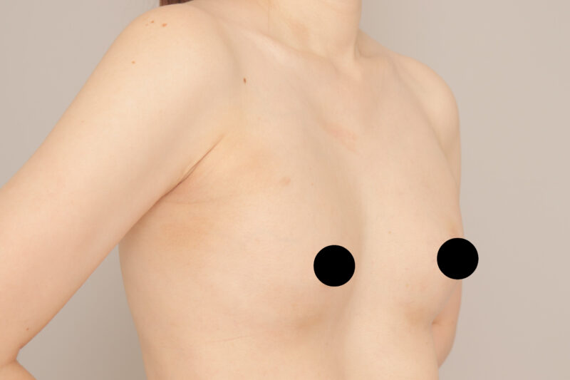 ベイザー脂肪吸引（１か月経過：33）の術後写真