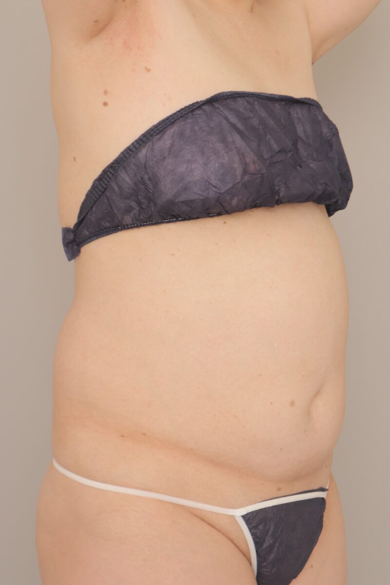 ベイザー脂肪吸引(半年経過:57)の術前写真