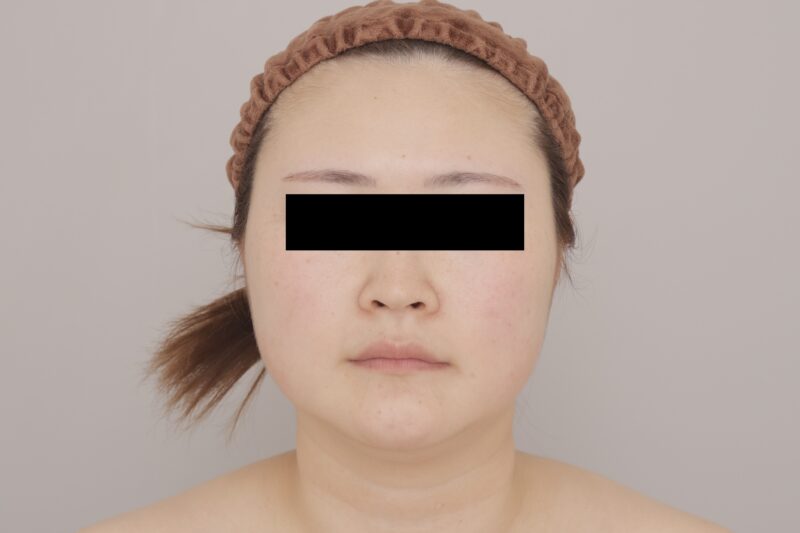 ベイザー脂肪吸引(3ヶ月経過:29)の術前写真