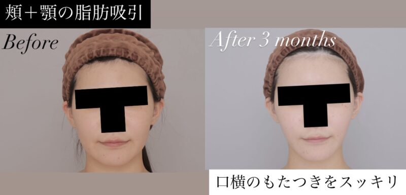●【頬+顎下】20代女性 158cm 57kgのモニター様●
