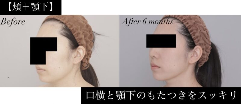 ●【頬+顎下】30代女性 157cm 48kgのモニター様●