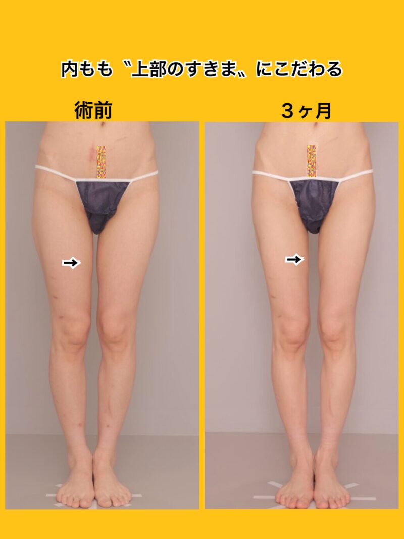 細身の方も、さらに細く。さらに内もものすきまを。～39歳151cm39kg太もも臀部８００cc吸引後３か月～