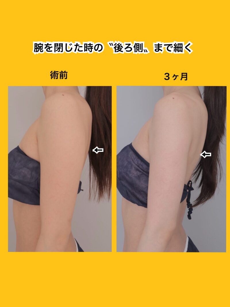 腕を閉じたときの後ろ側まで細くできます～163cm47kg上腕肩脇肉400cc吸引後3か月～