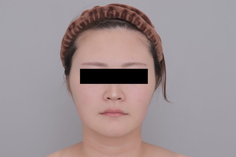 ベイザー脂肪吸引(3ヶ月経過:29)の術後写真