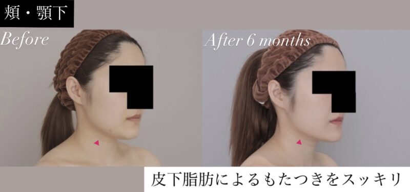 ●【頬＋顎下】20代女性 162cm 50kgのモニター様●