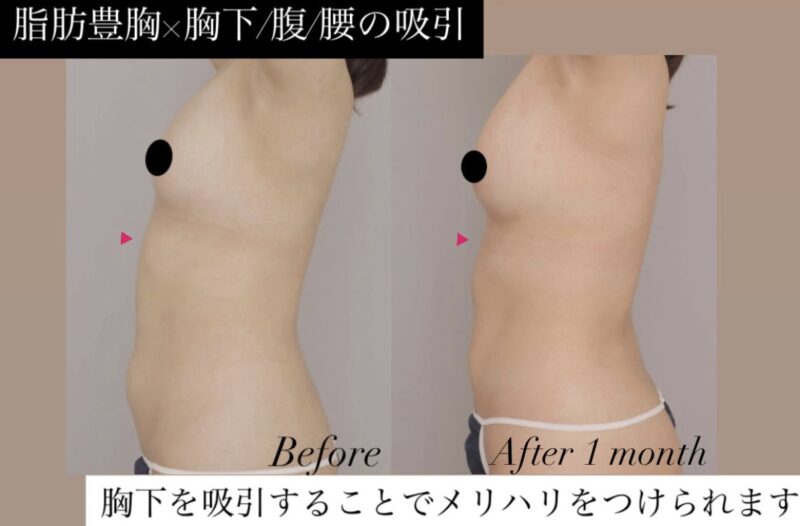 ●【脂肪豊胸（1回）×胸下・腹・腰の脂肪吸引】20代女性 145cm 50kg 骨格のストレートの女性モニター様●