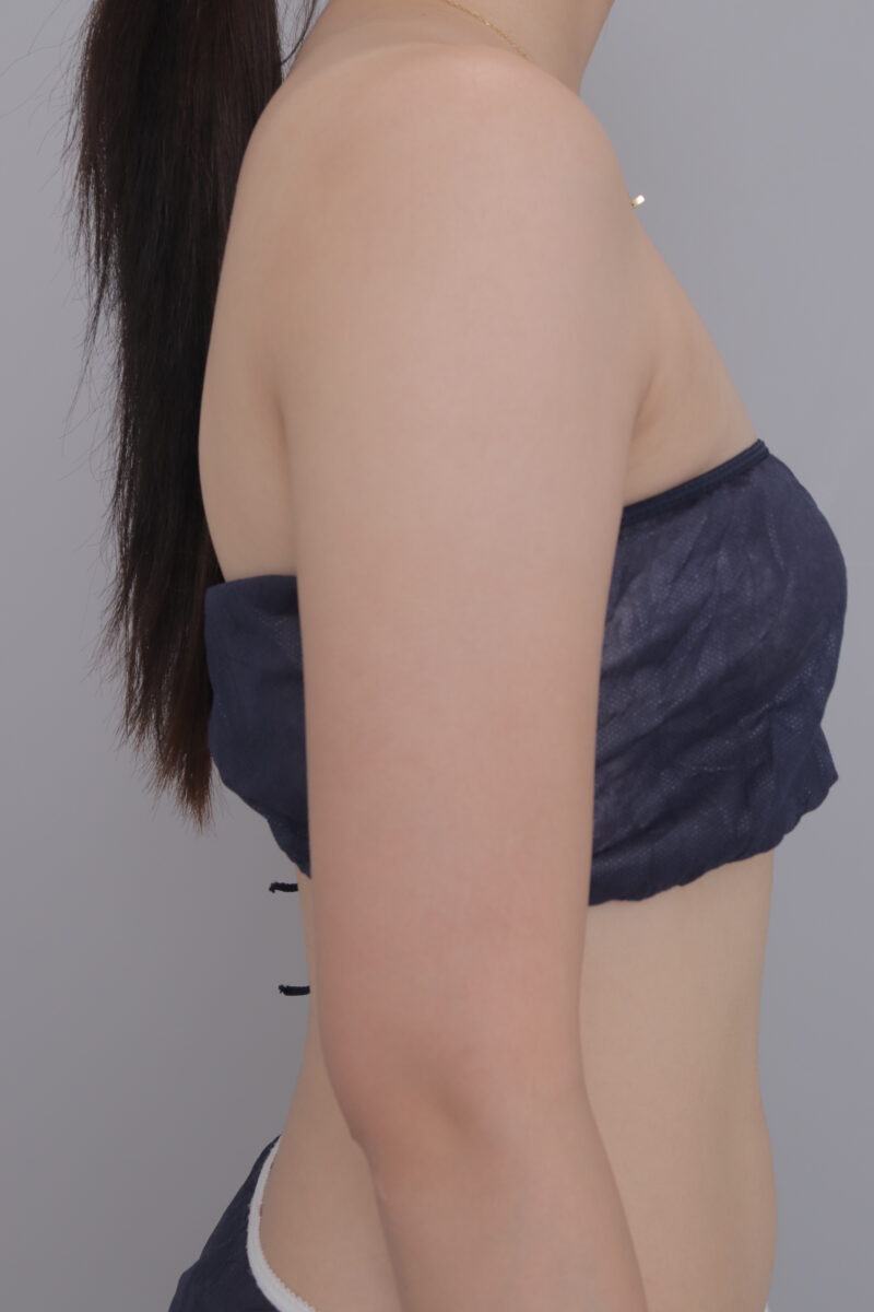 20代女性・腕吸引・1ヶ月でこの変化量！？