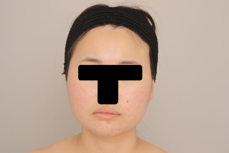 ベイザー脂肪吸引（６か月経過：21）の術前写真