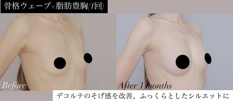 ●骨格ウェーブ×脂肪豊胸（1回）(20代女性 152cm 47kg)