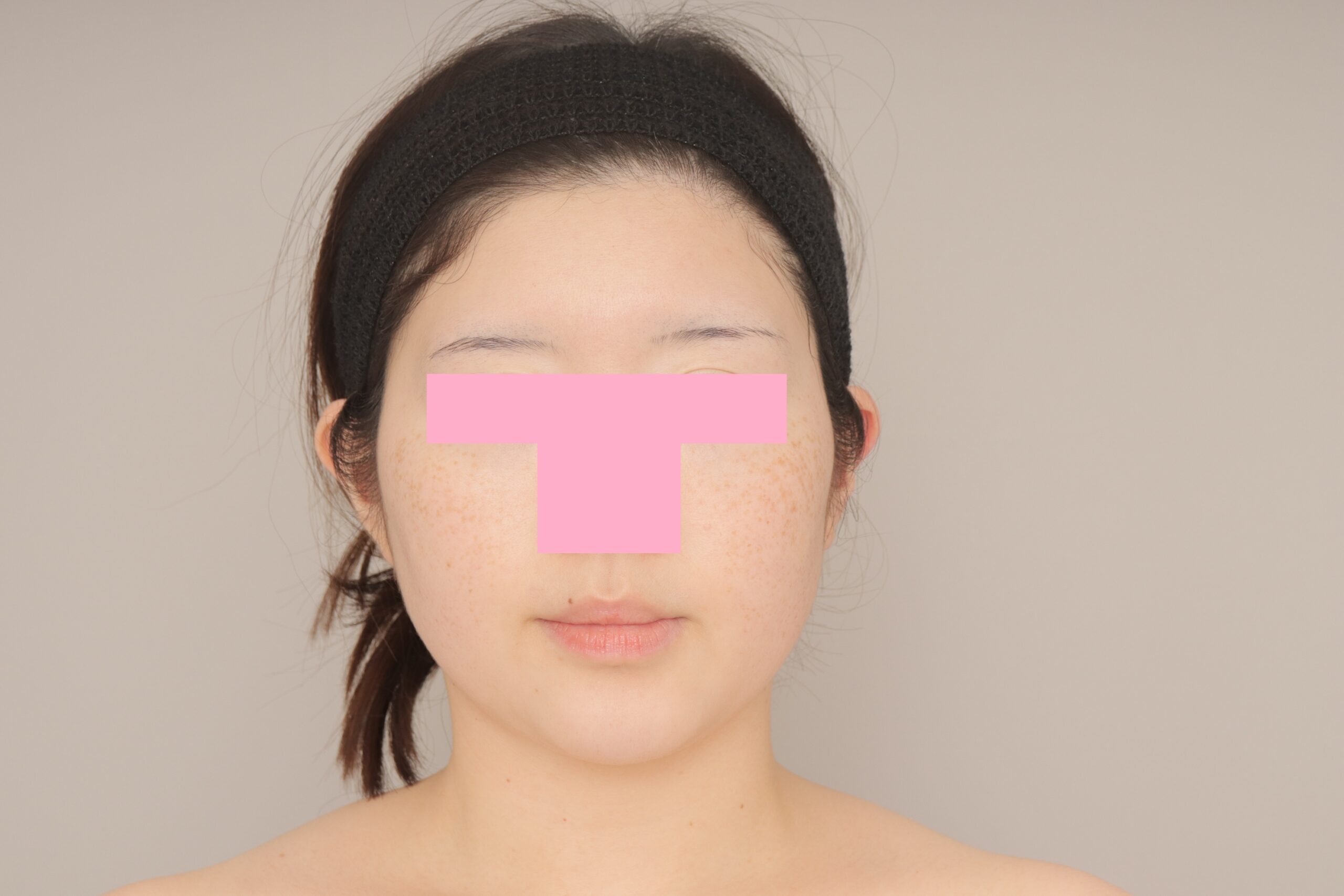 ベイザー脂肪吸引（3か月経過：31）の術前写真