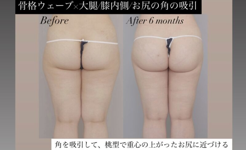 ●骨格ウェーブ×太腿全周+膝＋臀部の脂肪吸引 (30代女性 148cm 52kg)