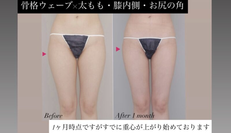 ●《術後1か月時点》骨格ウェーブ×太腿全周+膝＋臀部の脂肪吸引 (20代女性 163cm 50kg)