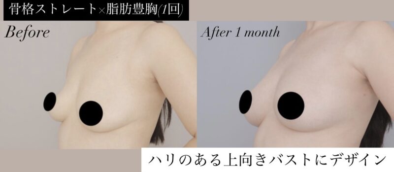 ●骨格ストレート×脂肪豊胸1回 (40代女性 160cm 50kg)