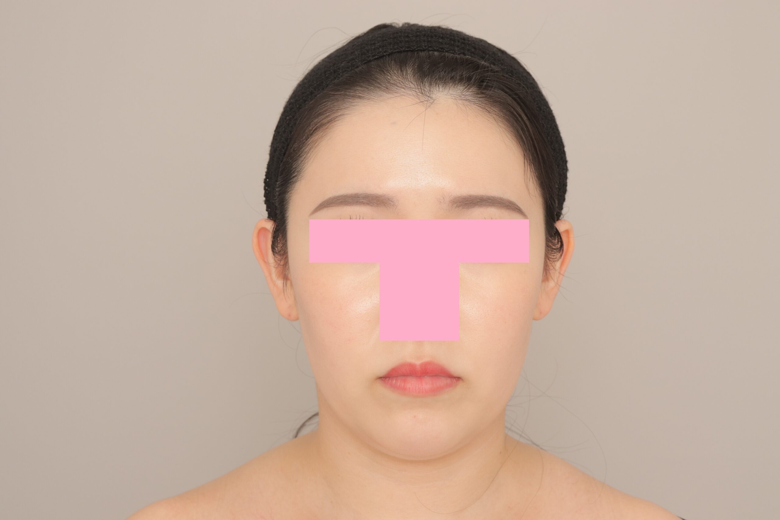 ベイザー脂肪吸引（6か月経過：28）の術後写真