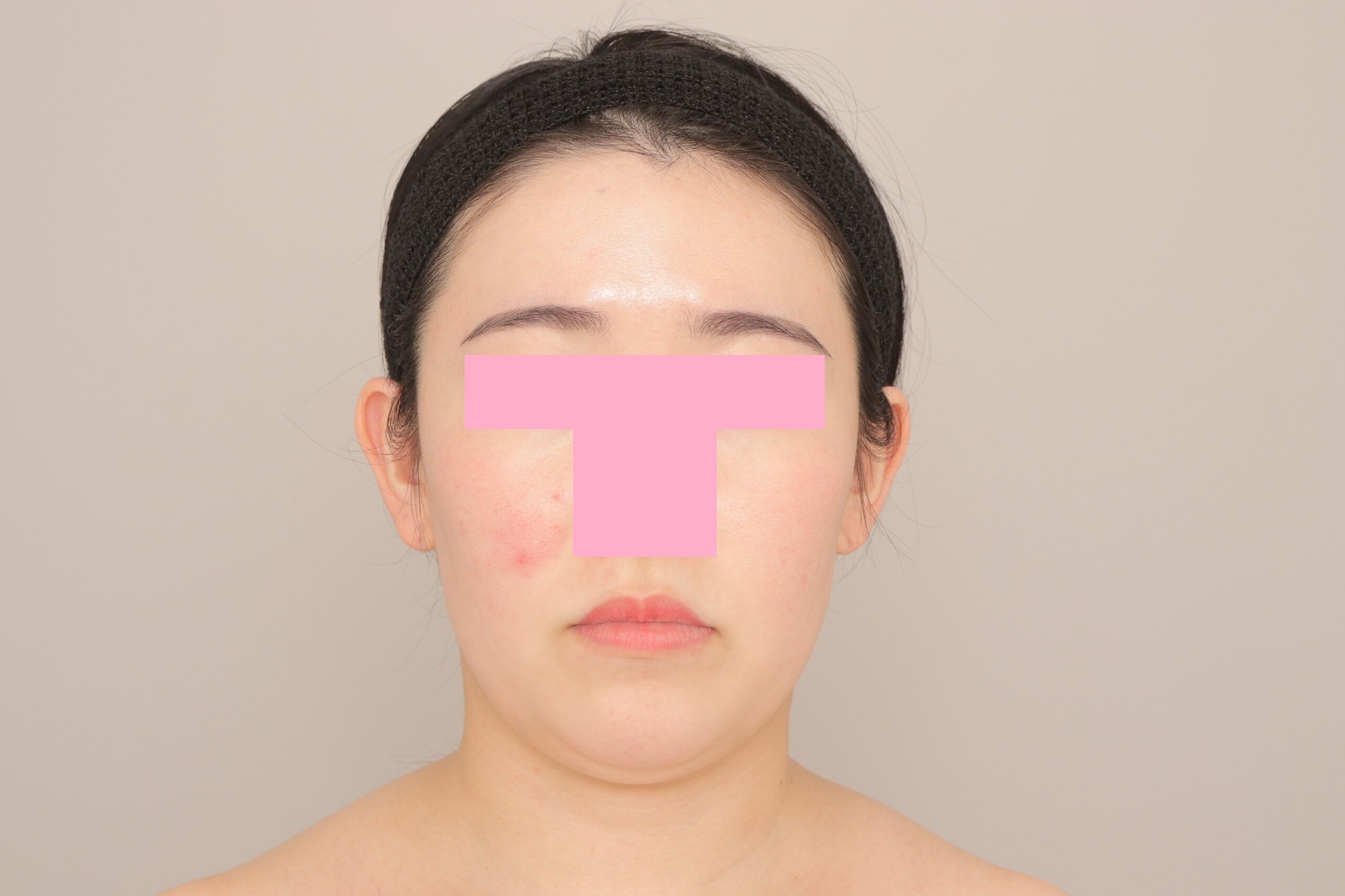ベイザー脂肪吸引（6か月経過：28）の術前写真