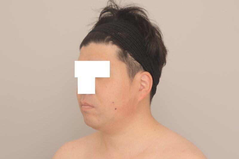 ベイザー脂肪吸引（半年経過：35）の術前写真