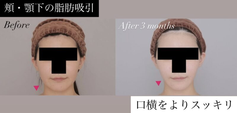 ●頬＋顎下(20代女性 158cm 57kg)