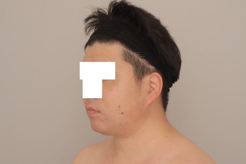 ベイザー脂肪吸引（半年経過：35）の術後写真